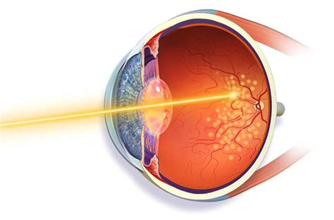 Retinal Laser Photocoagulation, Retinal Tear Surgery