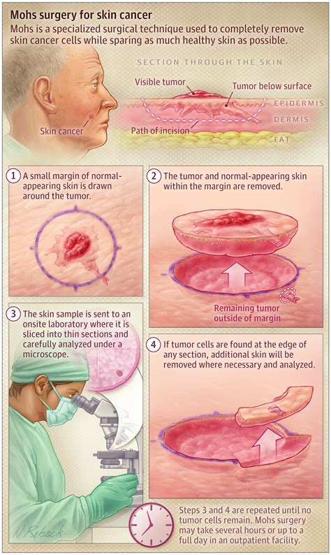 What Is Mohs Surgery? | Dermatology | JAMA Dermatology | JAMA Network