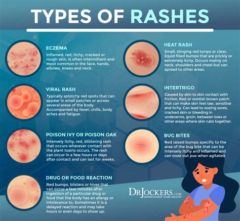 Skin rash after finishing antibiotics