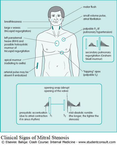 Heart Murmurs and Valvular Diseases - Differential Diagnosis ...