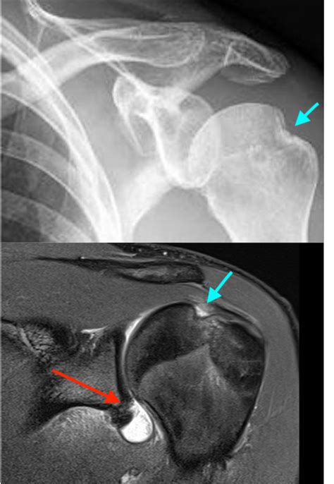 Bankart - Hill-Sachs lesions