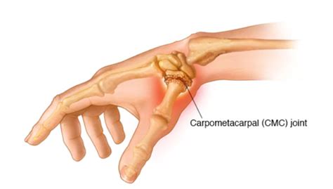 Thumb Pain: Where Is the CMC Joint and Why Does It Hurt so Bad? - Wieber PT