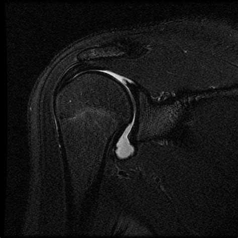 Normal Shoulder Mri Arthrogram