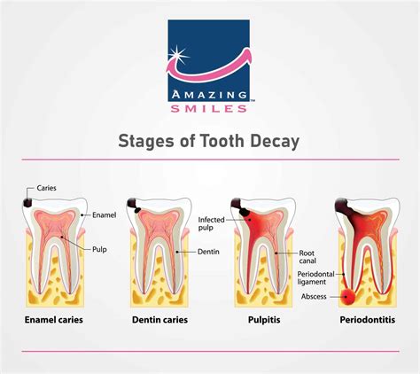 Stages Of Tooth Decay - Tooth Caries - Amazing Smiles