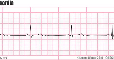 ECG Educator Blog : Sinus Bradycardia