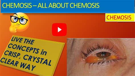 CHEMOSIS- ALL ABOUT CHEMOSIS, What is chemosis? Causes of Chemosis ...