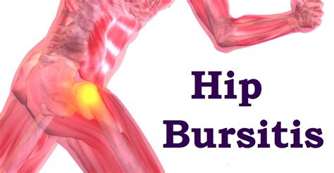 HIP BURSITIS SYMPTOMS, RELIEF AND PHYSICAL THERAPY - Rehab Experts