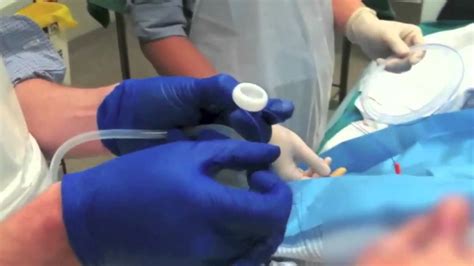 Peg Tube Insertion Video - YouTube