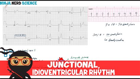 Accelerated Junctional Rhythm