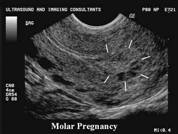 How Early Can A Molar Pregnancy Be Detected By Ultrasound - PregnancyWalls