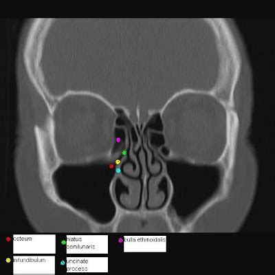 Head and Neck Imaging: Osteomeatal complex