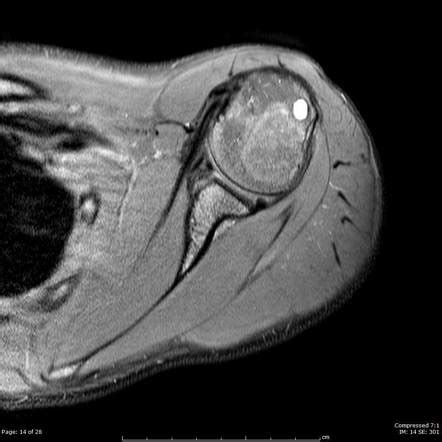 Bankart Lesion Mri