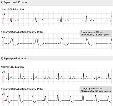 ECG interpretation: Characteristics of the normal ECG (P-wave, QRS ...