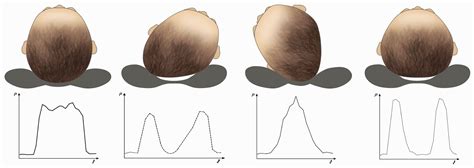 Specially Designed Baby Pillow for Plagiocephaly and Brachycephaly ...