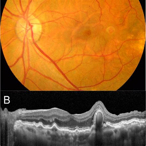 Images acquired 6 years after the patient's epiretinal membrane ...