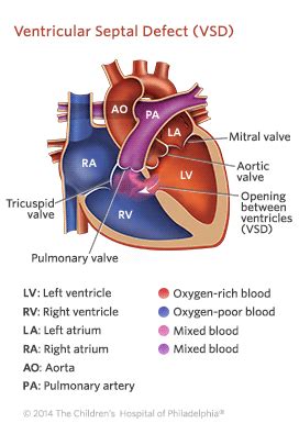 Ventricular Septal Defect (VSD): What Is It, Types, Causes, 43% OFF