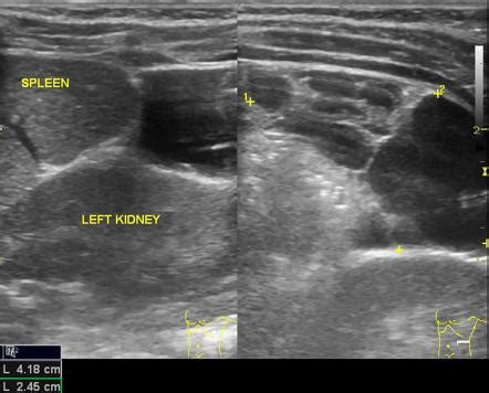 Lymphangioma | Radiology Reference Article | Radiopaedia.org