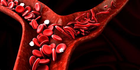 Sickle Cell Disease And Cancer | www.informationsecuritysummit.org