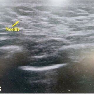 The serratus anterior block technique: (A) Sonographic anatomy of the ...