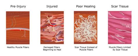 Ask the doc: What is Soft Tissue & Why Does it Matter?