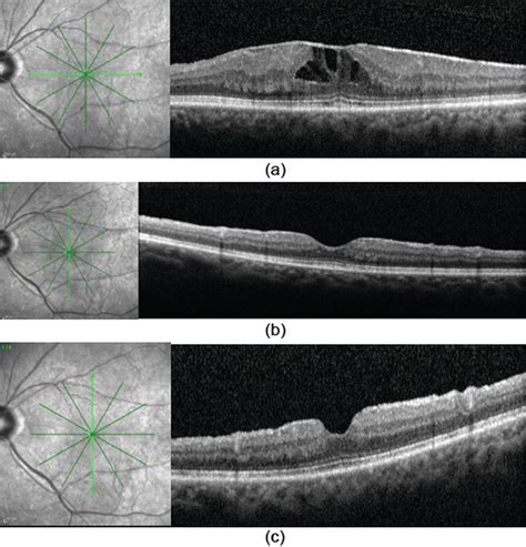 Epiretinal Membrane Oct