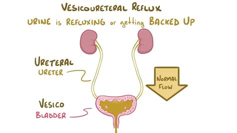 Vesicoureteral reflux: Video, Anatomy & Definition | Osmosis