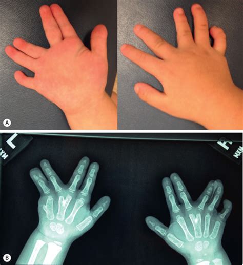 Polydactyly Reconstruction | Plastic Surgery Key