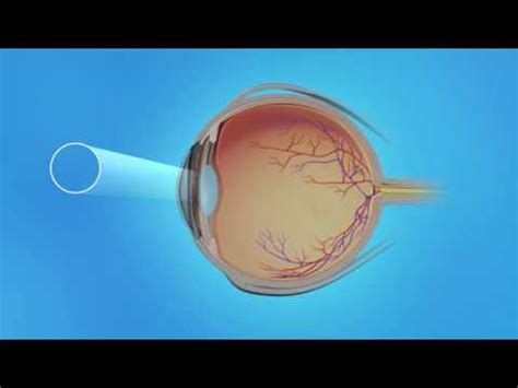 Macular Pucker: Vitrectomy Surgery - YouTube