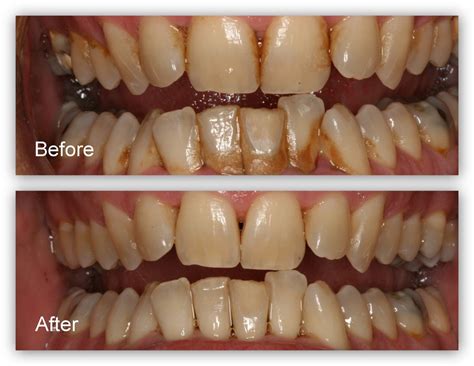 Gum Disease Gallery - Dr. Jack M. Hosner, D.D.S.