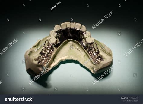 Removable Partial Denture Metal Framework Patient Stock Photo ...