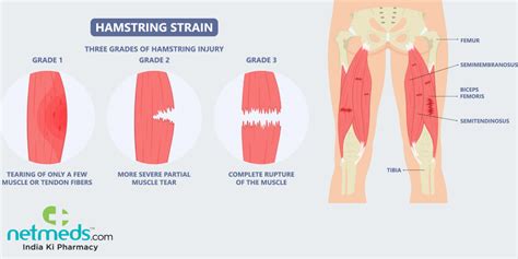 Pulled Hamstring Diagram