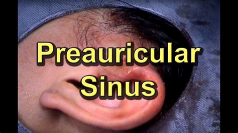 Preauricular Ear Sinus Infection - YouTube