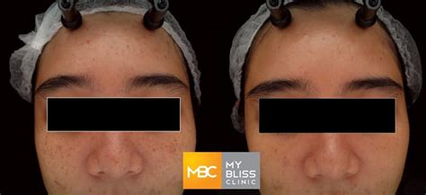 pigment laser before after 2 | My Bliss Clinic