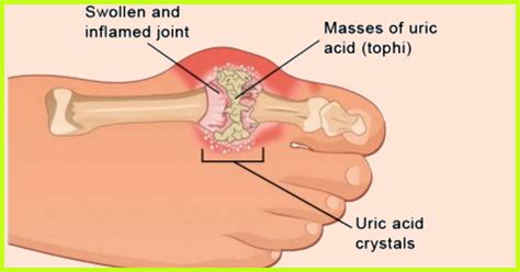 Gout Diet To Reduce Uric Acid: Foods To Eat And Avoid