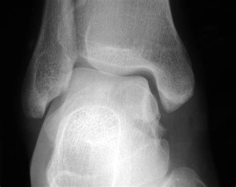 Talus Bone Fracture