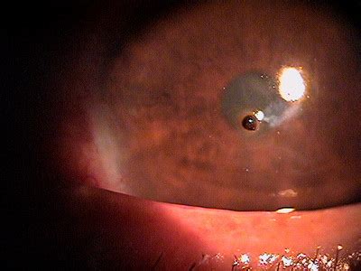 Corneal Foreign Body Removal - Decision-Maker PLUS