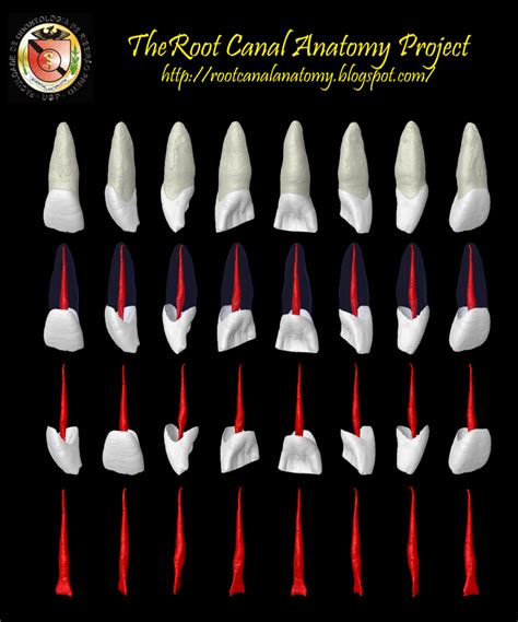 The Root Canal Anatomy Project: Maxillary Central Incisor