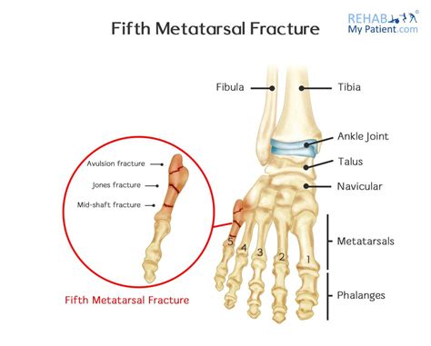 5th Metatarsal Fracture - Motus Physical Therapy