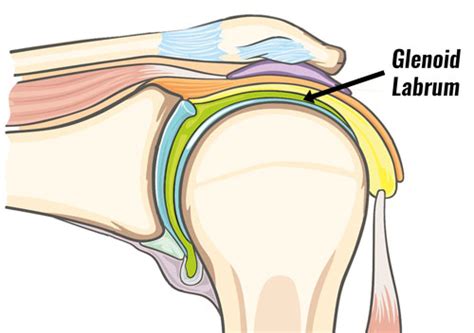 Glenoid Labrum Tear - Symptoms, Causes, Treatment and Rehabilitation