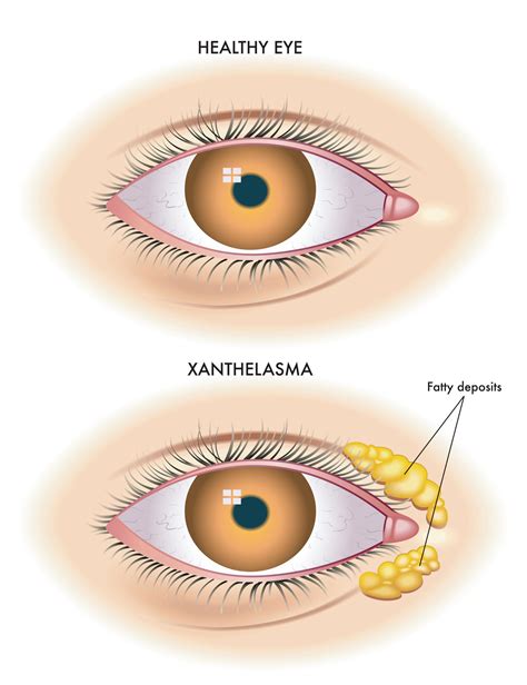 Xanthelasma: Causes, Symptoms and Treatment I Prima Health