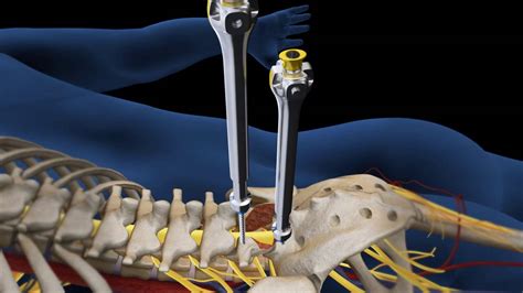 Lumbar Fusion of L5 S1 Animation - YouTube