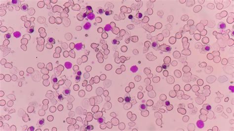 Thalassemia Blood