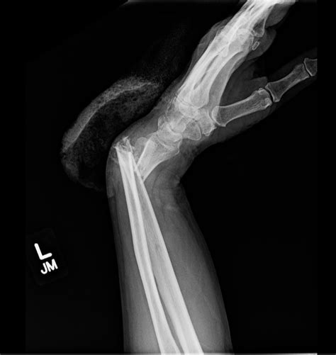 Distal Radius Fractures — BROWN EMERGENCY MEDICINE