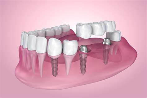 3 Types of Dental Implants - Dentist in Asheville, NC