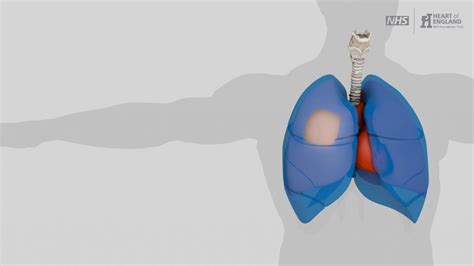 Pleural biopsy | Thoracic Surgery University Hospitals Birmingham