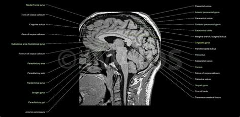 Anatomy of the brain (MRI) | Mri brain, Brain anatomy, Mri