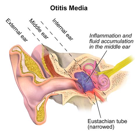 Bulging ear drums and hearing loss: Aboriginal kids have the highest ...