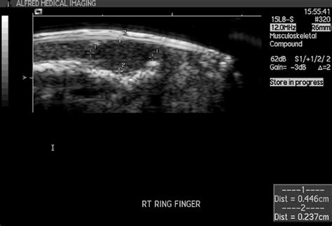 Glomus tumor ultrasound - wikidoc