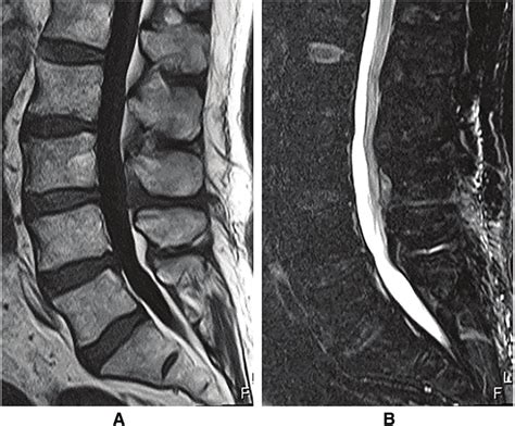 (A and B) MRI of the lumbar spine taken one month after conversion of ...