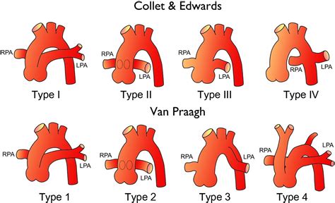 Truncus Arteriosus | Heart